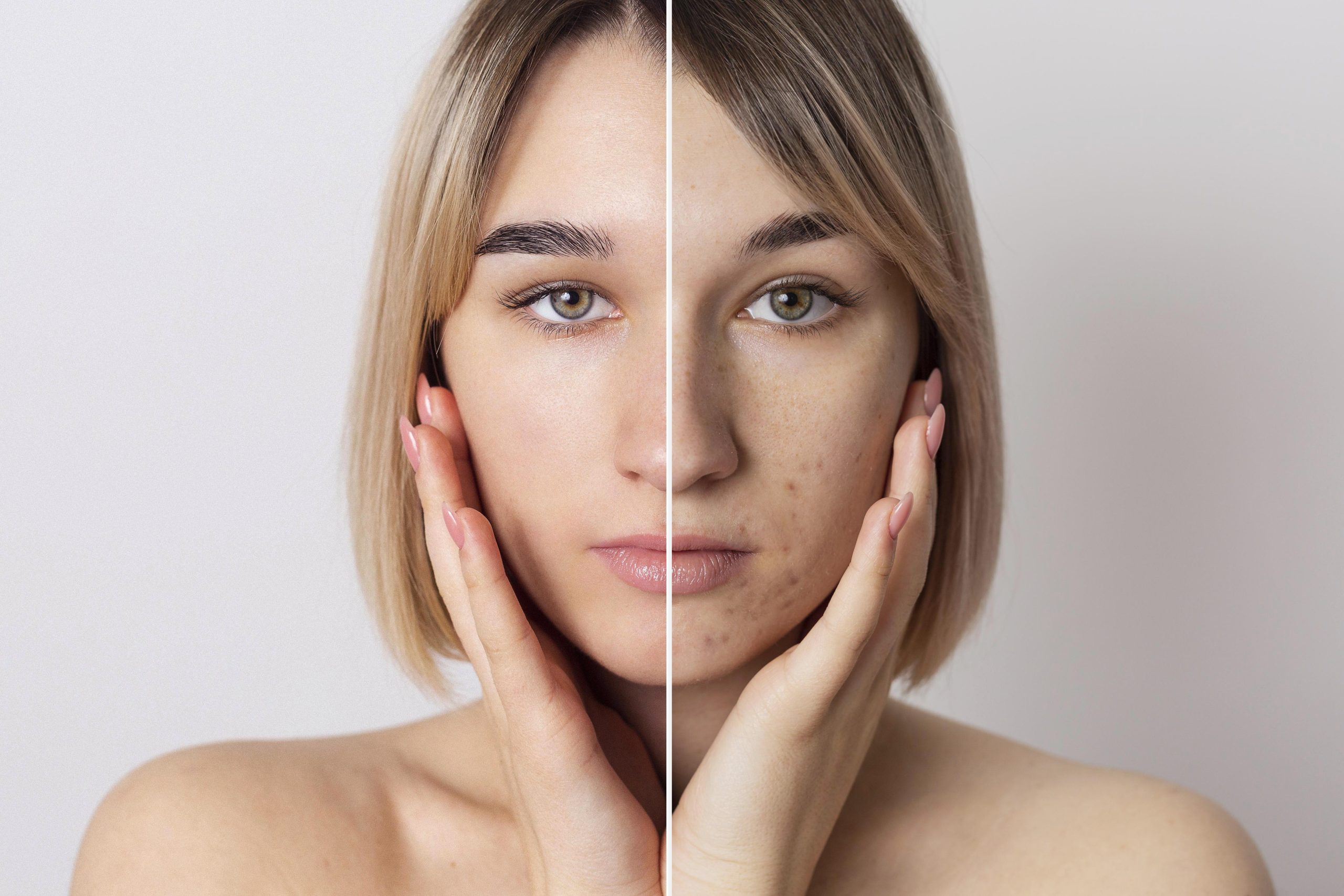 Clear Skin Mastery: A Comprehensive Guide to Acne Treatment and Prevention